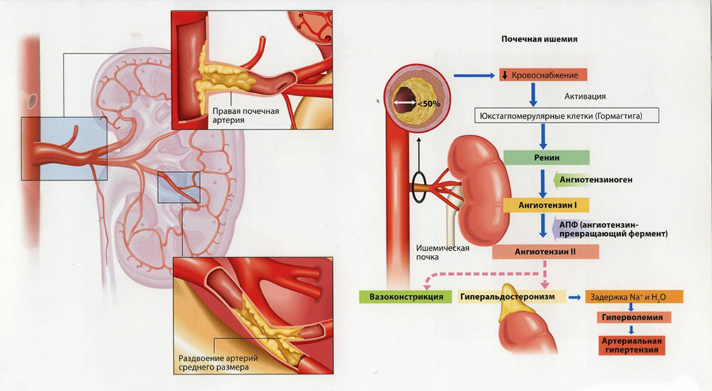 Изображение - Небольшой разрыв между верхним и нижним давлением Shema-ateroskleroza-pochechnyh-arterij