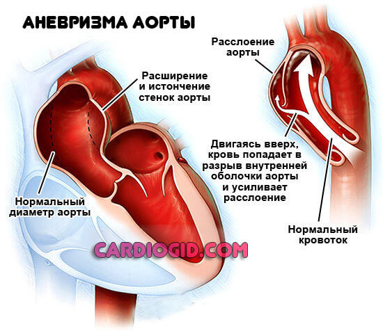 Изображение - Маленькая разбежка между верхним и нижним давлением anevrizma-aorty-serdtsa