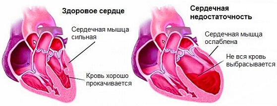 Изображение - Разница между пульсом и давлением serdechnaya-nedostatochnost