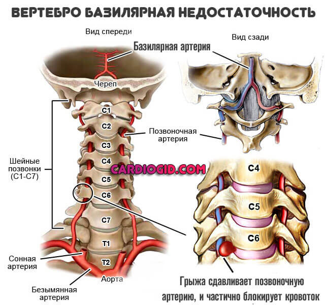Изображение - Верхнее давление ниже нормы vertebrobazilyarnaya-nedostatochnost-1
