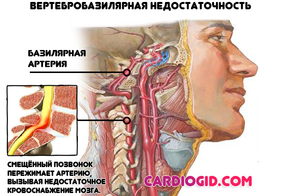 Изображение - Почему повышается давление у человека вечером vertebrobazilyarnaya-nedostatochnost