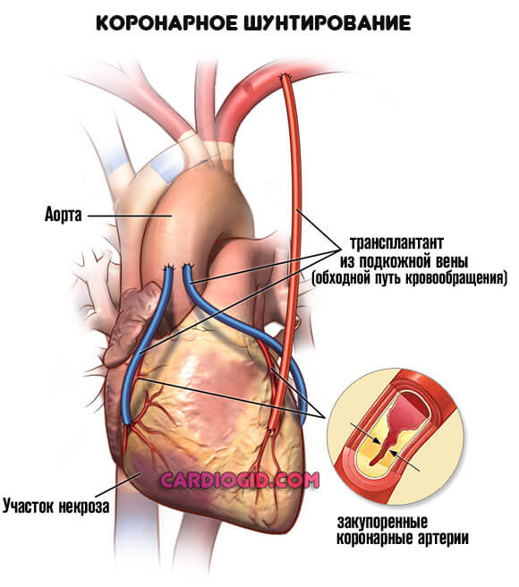 Ибс атеросклеротический кардиосклероз атеросклероз аорты коронарных артерий thumbnail