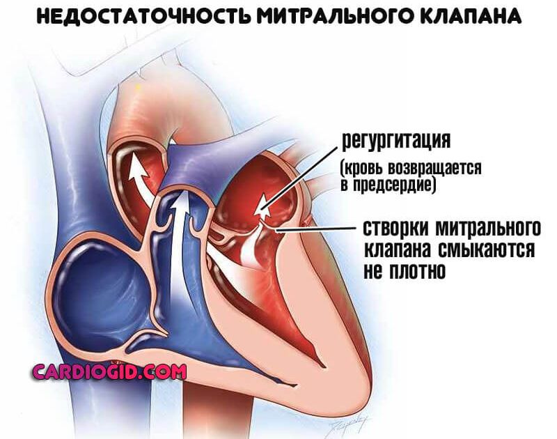 Как вылечить правый желудочек сердца thumbnail