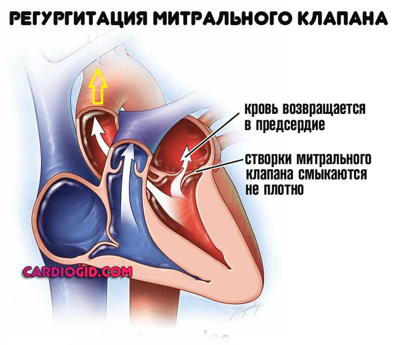 Асистолия при инфаркте миокарда thumbnail