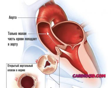 аортальный-стеноз