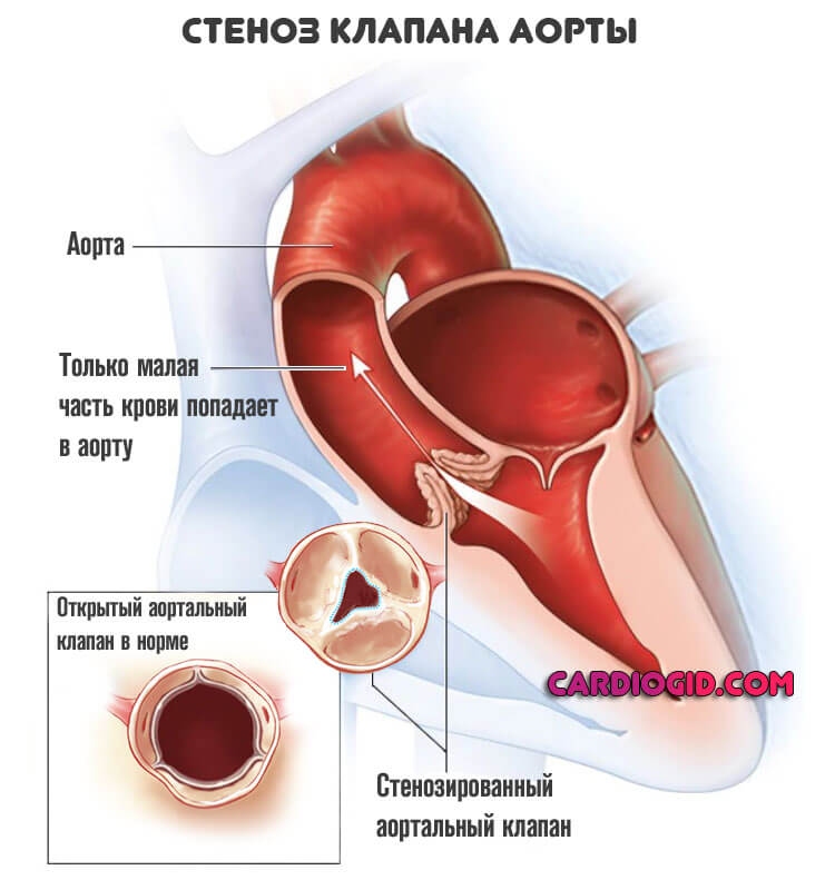 Схема левожелудочковой сердечной недостаточности thumbnail