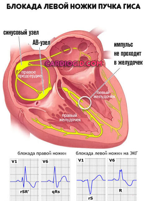 Гипертрофическая кардиомиопатия при гипертонии thumbnail