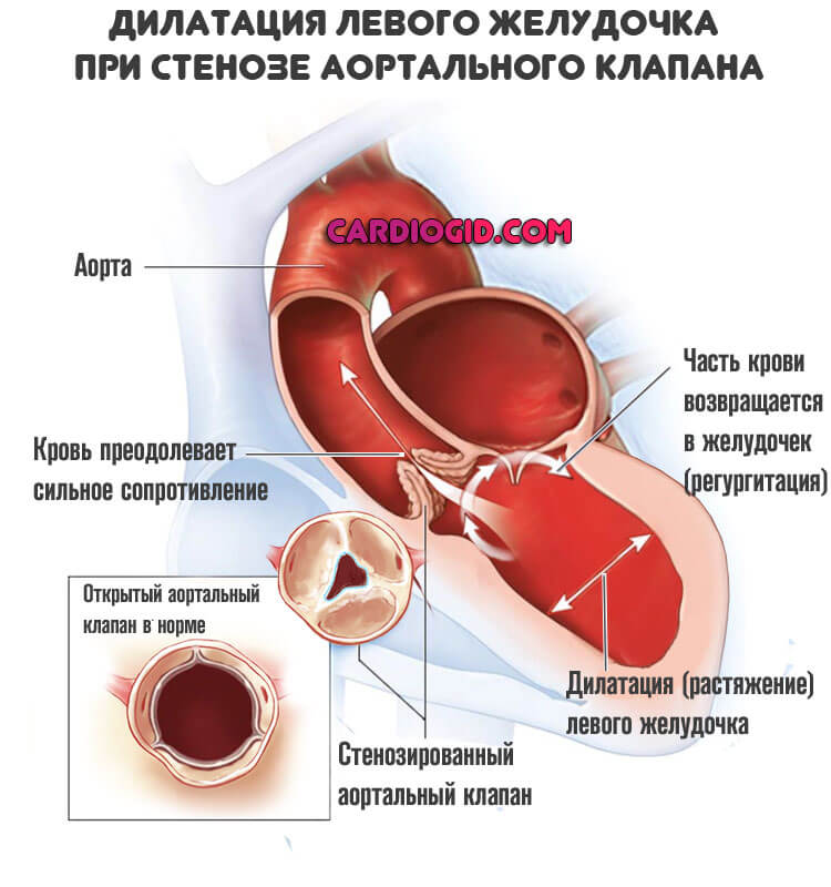 дилатация-левого-желудочка при стенозе клапана аорты