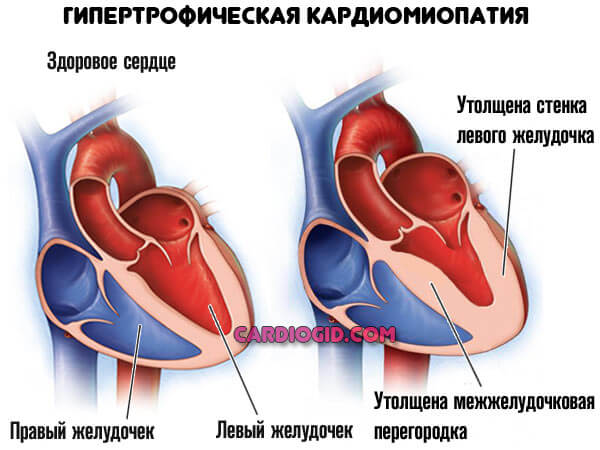 гипертрофическая-кардиомиопатия
