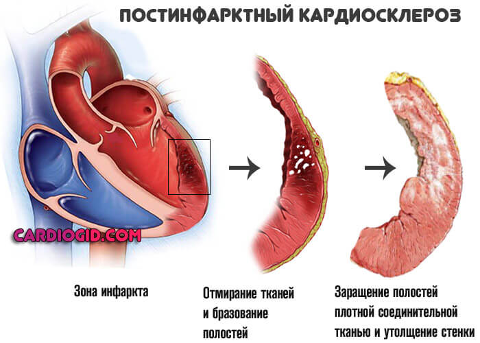 postinfarktnyj kardioskleroz