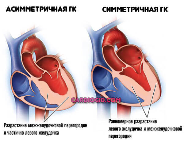Хроническая сердечная недостаточность по левожелудочковому типу thumbnail