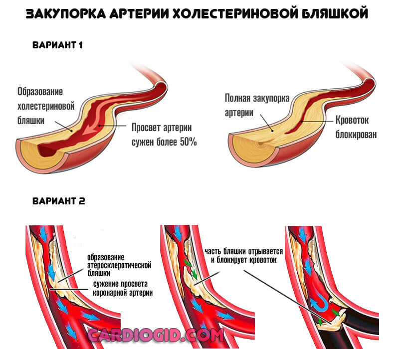 Острый трансмуральный инфаркт нижней миокарды thumbnail