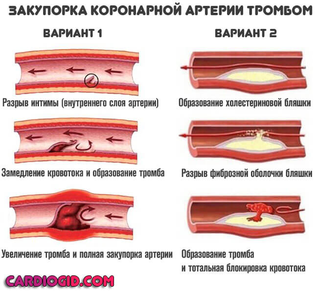 закупорка-коронарной-артерии-тромбом