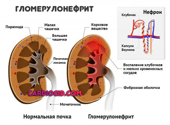 Изображение - Разница между пульсом и давлением Glomerulonefrit