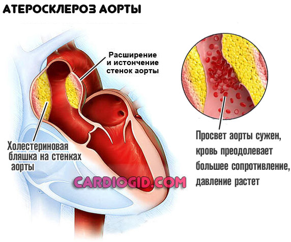 Изображение - Нижнее давление 100 у мужчин ateroskleroz-aorty