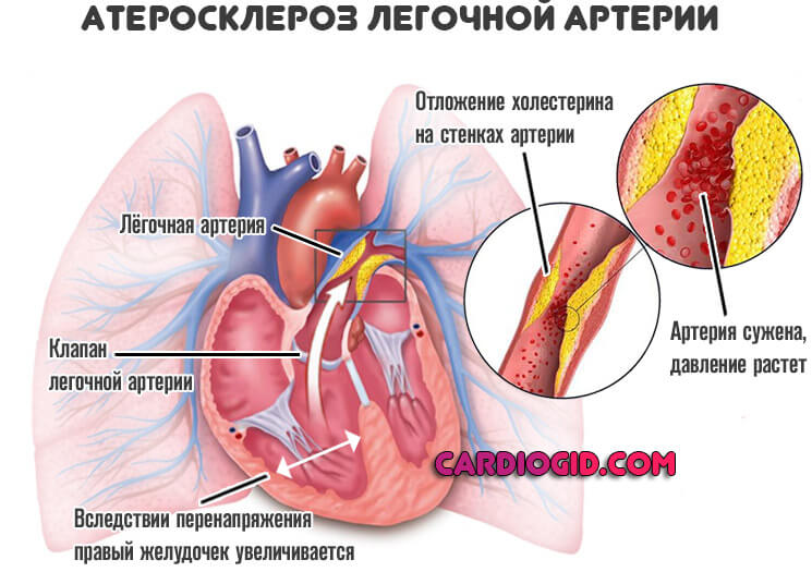Изображение - Давление 152 на 80 у мужчины ateroskleroz-legochnoj-arterii