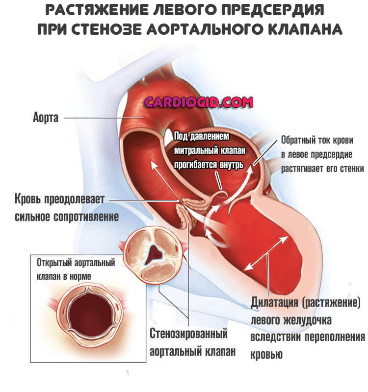 Хроническая аневризма сердца осложнение инфаркта thumbnail