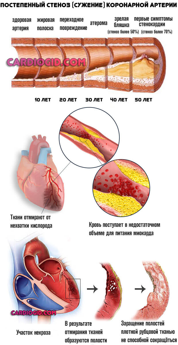 Симптомы инфаркта у женщин пожилого возраста лечение thumbnail