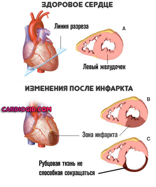 Изображение - Падает верхнее давление причины что делать kardioskleroz-posle-infarkta