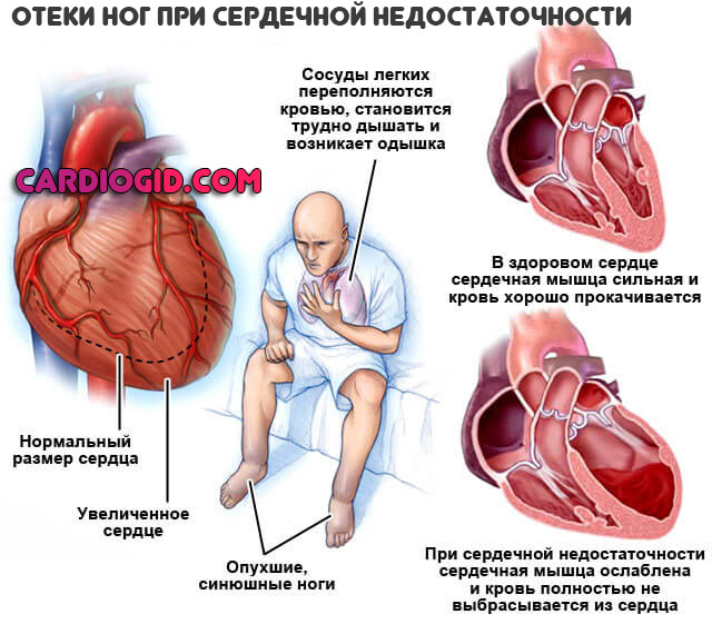 Что такое аневризма сердца: симптомы и причины, методы лечения и прогноз жизни
