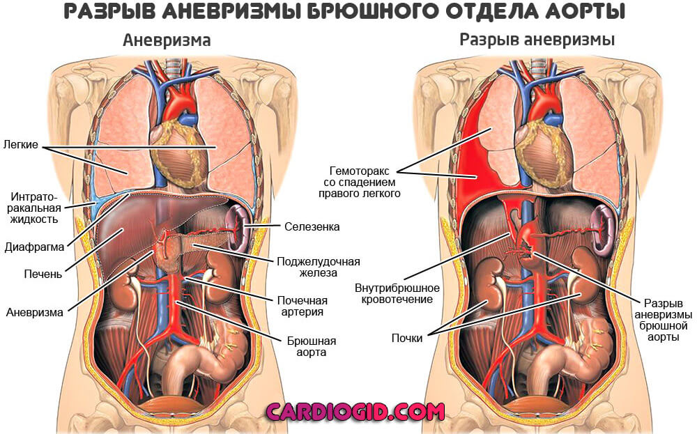 Расслаивающая аневризма аорты анализ крови thumbnail