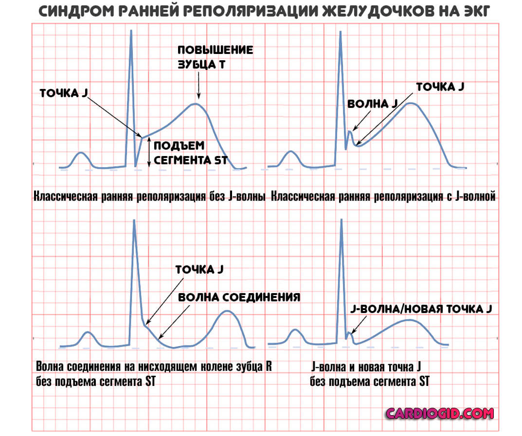 Синдром ранней реполяризации желудочков на кардиограмме thumbnail