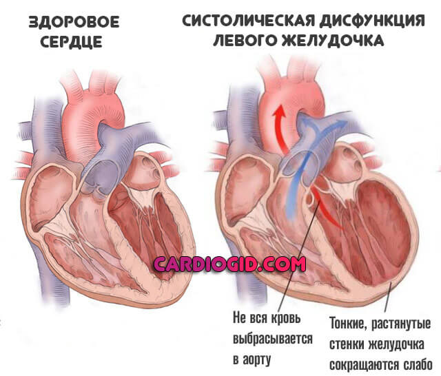 Хроническая сердечная недостаточность симптомы и лечение декомпенсация thumbnail