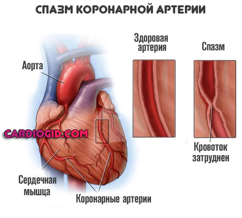 Как вылечить спазм артерии thumbnail