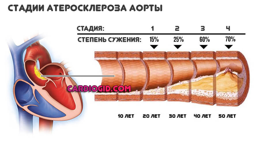 Изображение - Маленькая разбежка между верхним и нижним давлением stadii-ateroskleroza-aorty