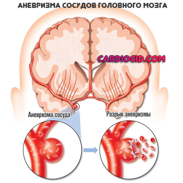 Обширное поражение головного мозга при инсульте прогноз thumbnail