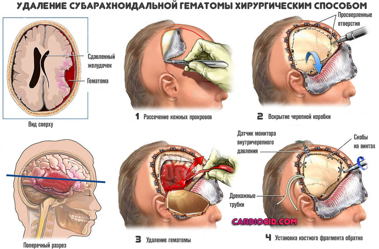 Симптомы отека головного мозга фото thumbnail