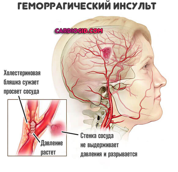 Изображение - Почему на разных руках разное артериальное давление gemorragicheskij-insult-1