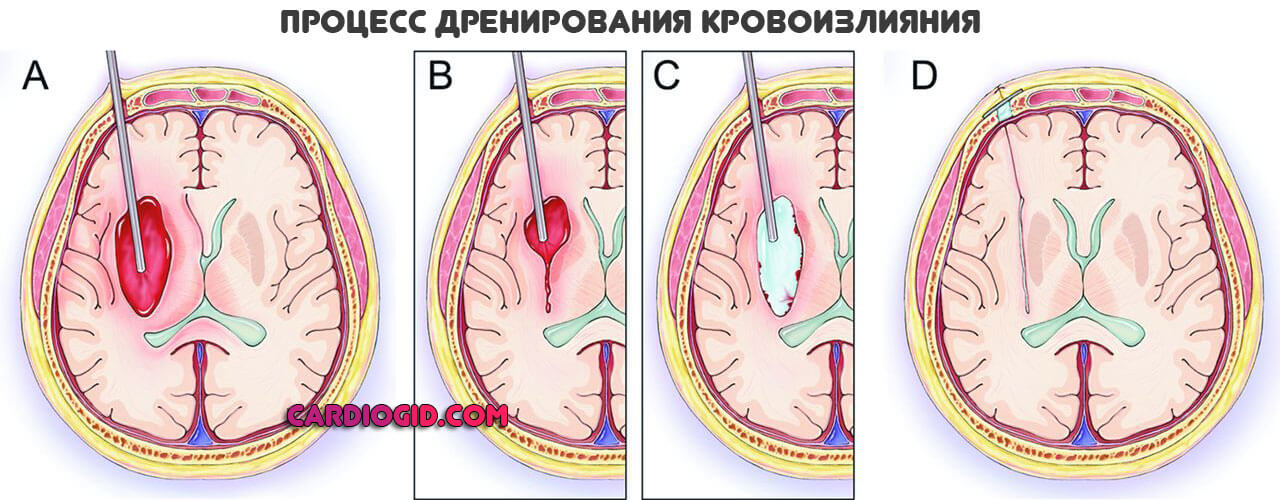Ишемический инсульт в левом полушарии мозжечка thumbnail