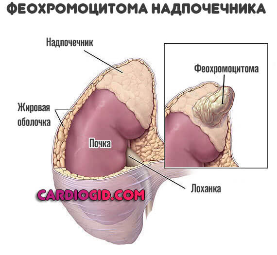 Изображение - Причины низкого нижнего артериального давления opuhol-nadpochechnika