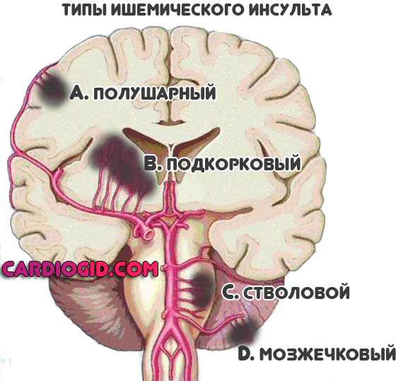Хроническая ишемия головного мозга на фоне атеросклероза thumbnail
