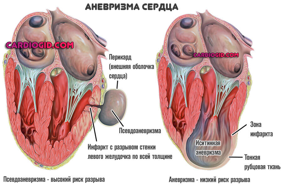 Что такое аневризма после инфаркта и как ее лечить thumbnail