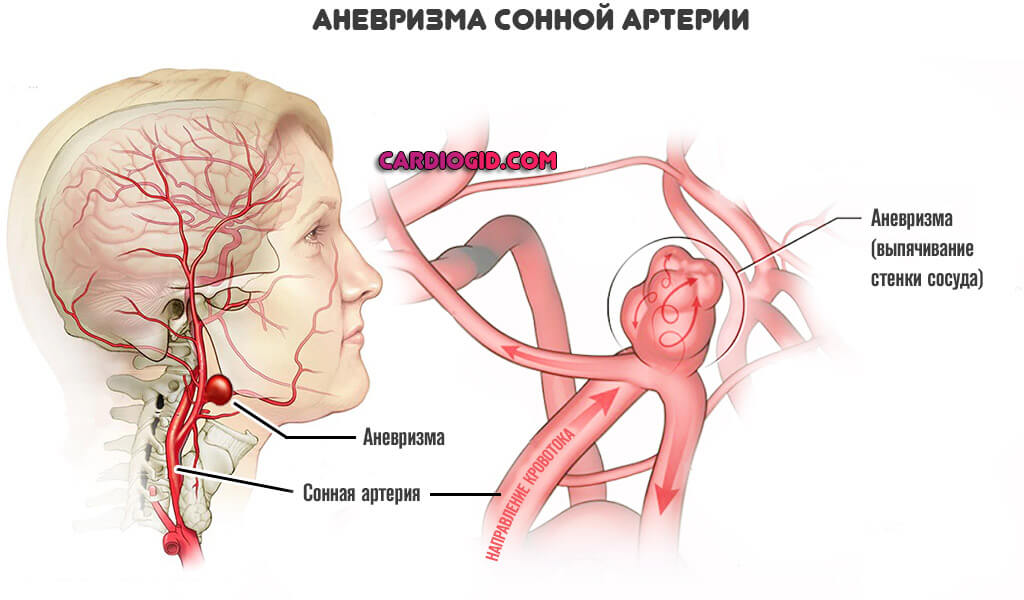 аневризма-сонной-артерии