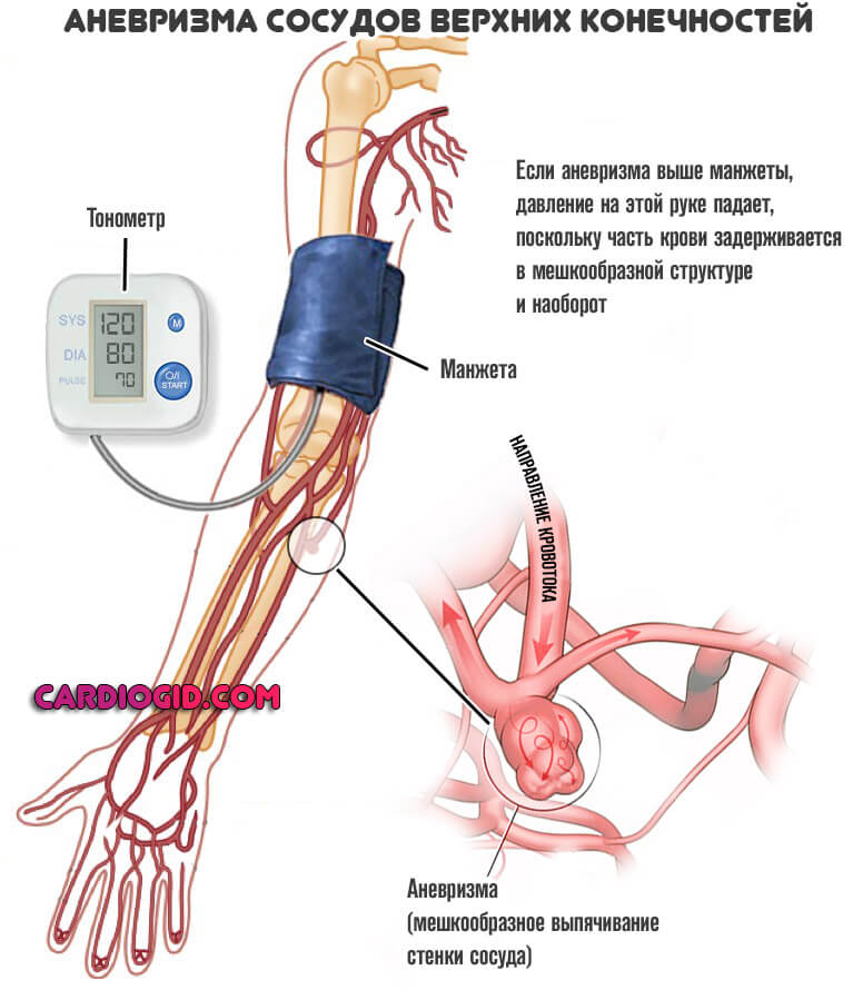 Изображение - Почему на разных руках разное артериальное давление anevrizma-sosudov-verhnih-konechnostej