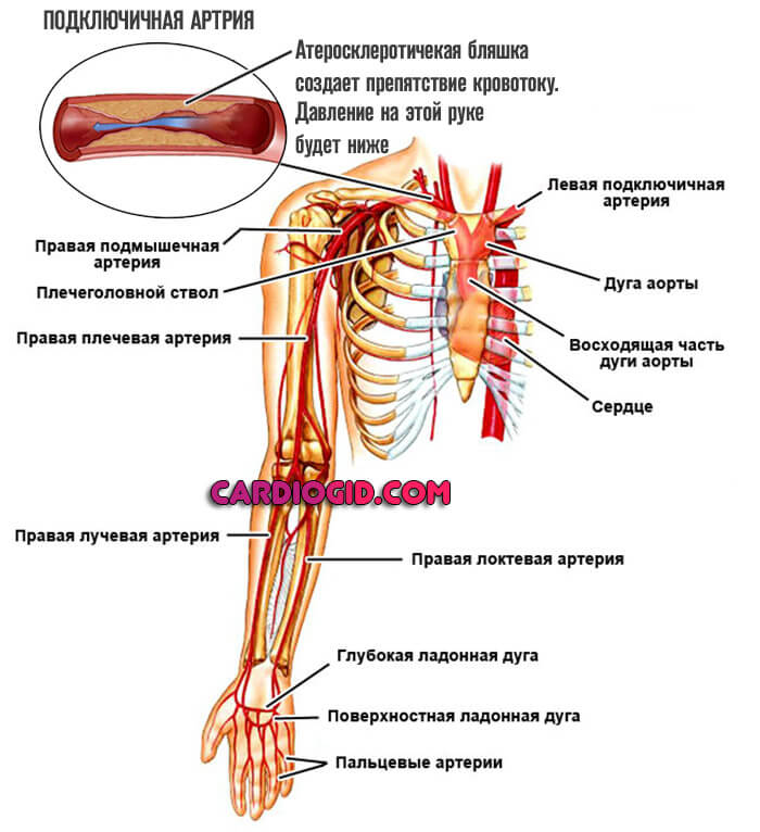 Изображение - Почему на разных руках разное артериальное давление ateroskleroz-podklyuchichnoj-arterii-1