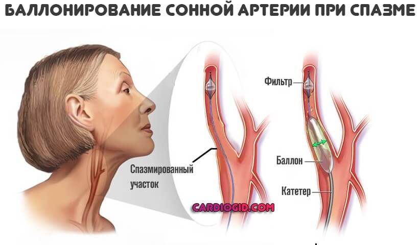 Атеросклероз внутренних сонных и позвоночных артерий thumbnail
