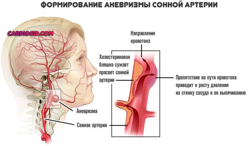 формирование аневризмы сонной артерии