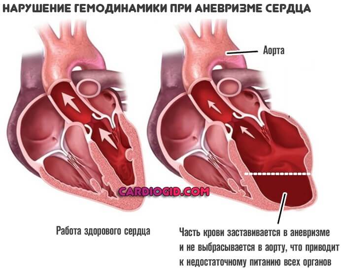 Как вылечить аневризм сердца thumbnail