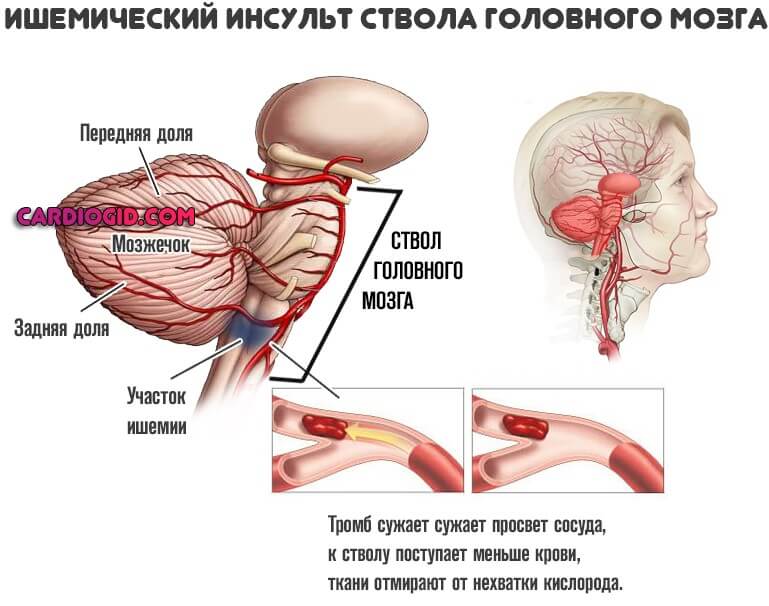 ишемический инсульт ствола головного мозга