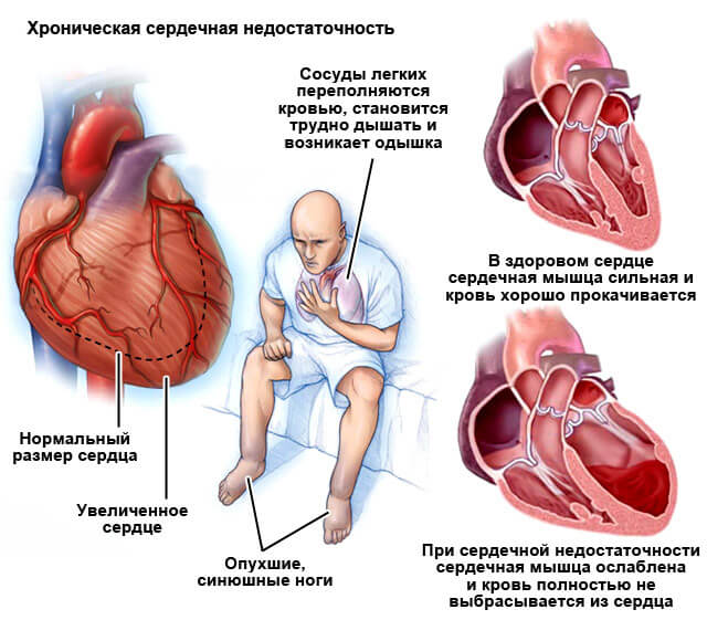 Изображение - Почему на разных руках разное артериальное давление oteki-nog-pri-serdechnoj-nedostatochnosti