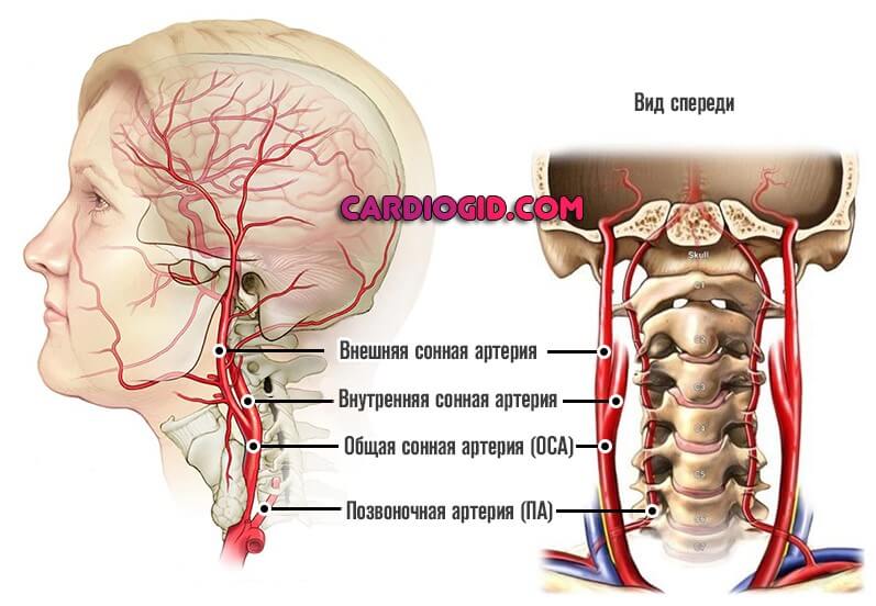 Атеросклероз внутренних сонных и позвоночных артерий от чего thumbnail