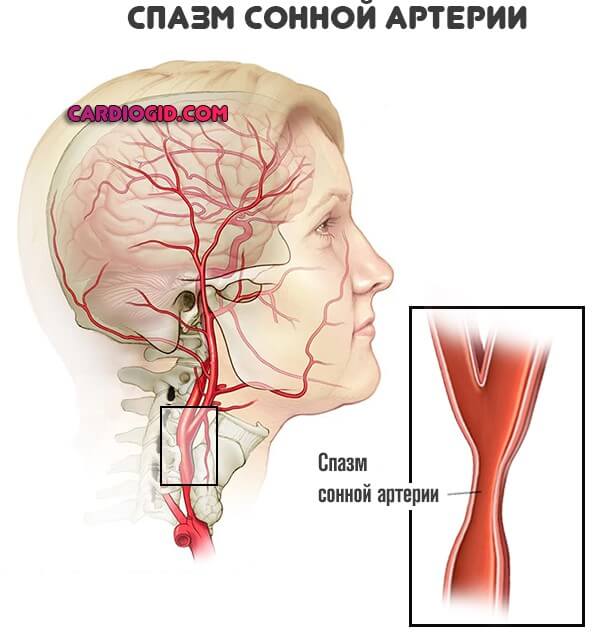 Атеросклероз сонной артерии симптомы лечение thumbnail
