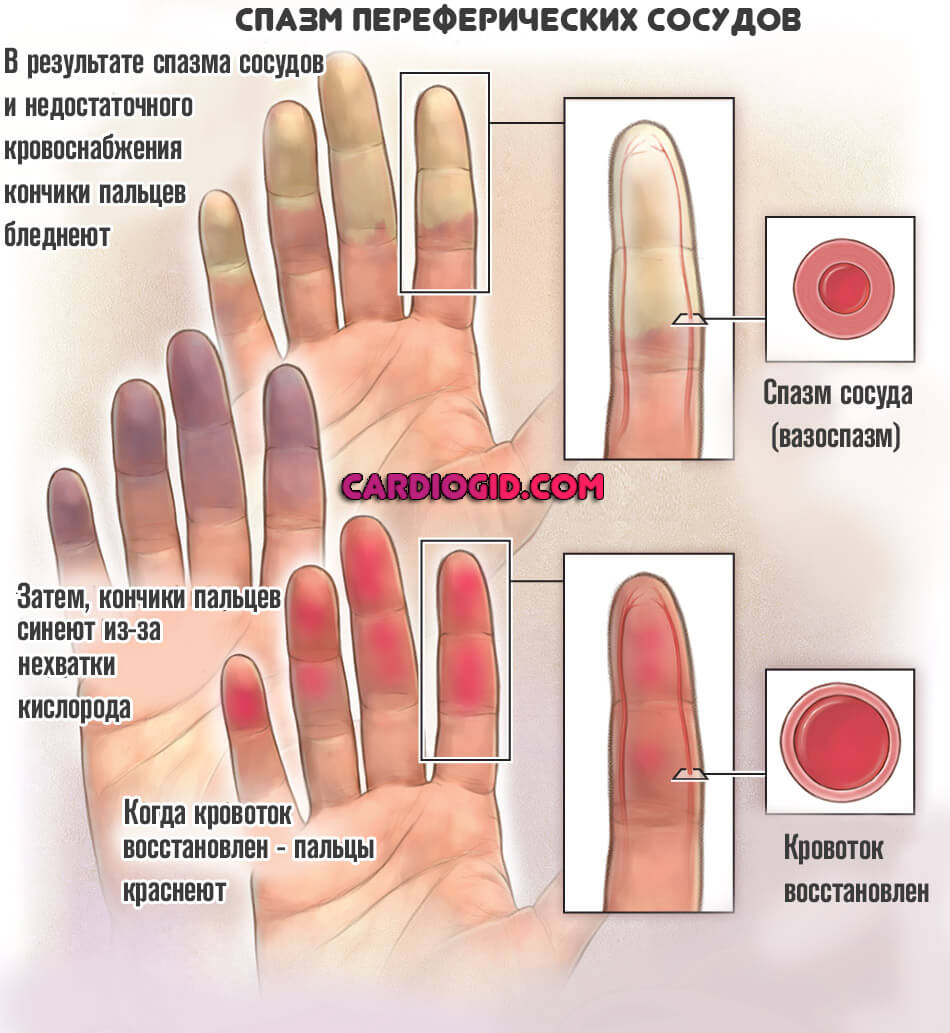 Изображение - Почему на разных руках разное артериальное давление spazm-sosudov-ruki
