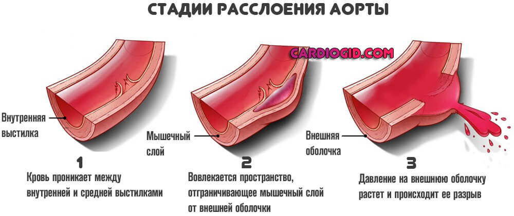 Изображение - Маленькая разбежка между верхним и нижним давлением stadii-rassloeniya-aorty