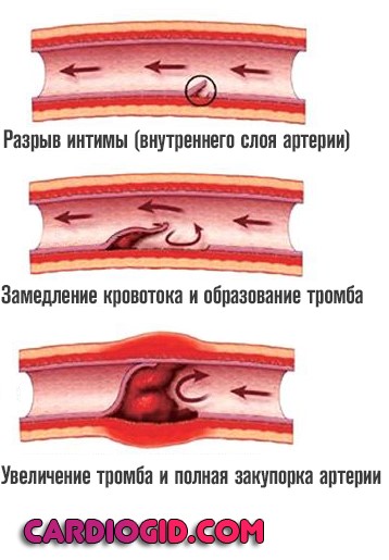Как определить тромб в ноге признаки фото лечение thumbnail