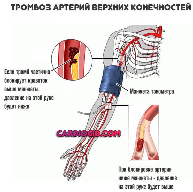 Изображение - Почему на разных руках разное артериальное давление tromboz-arterij-verhnih-konechnostej